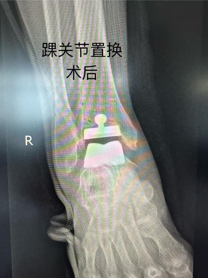 郴州市首例！湘南學(xué)院附屬醫(yī)院成功實(shí)施 3D 打印導(dǎo)板下踝關(guān)節(jié)置換術(shù)1 (4).jpg