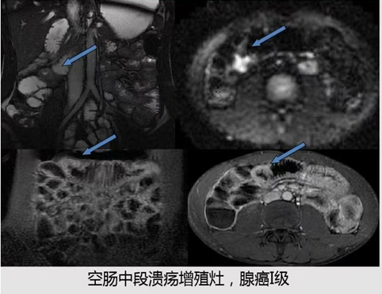 讓小腸病變無處遁形 